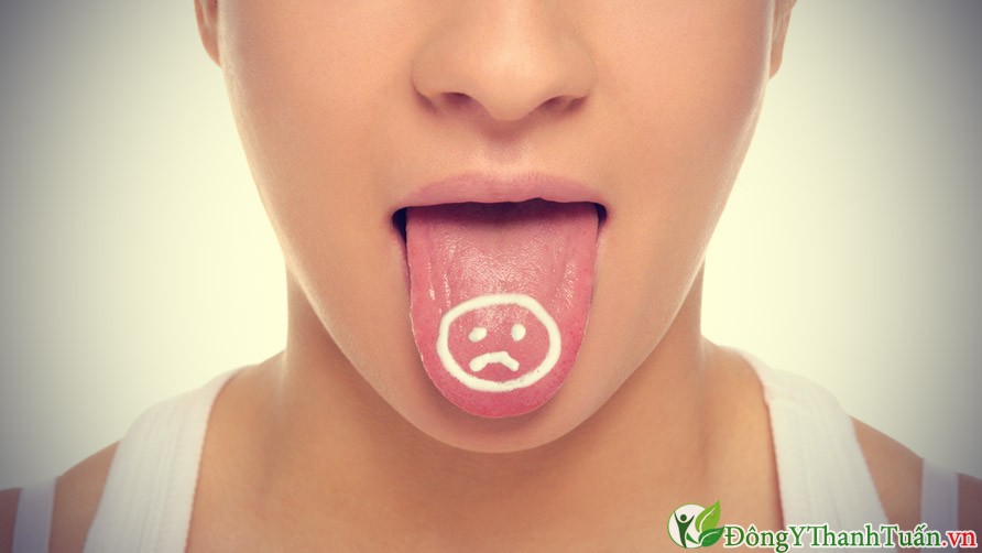 Dấu hiệu của bệnh nhiệt miệng