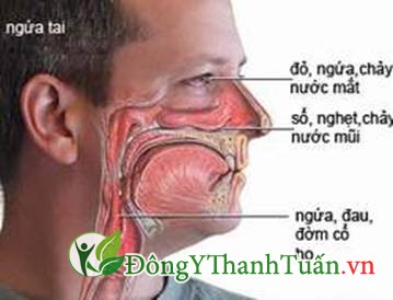 triệu chứng viêm mũi dị ứng
