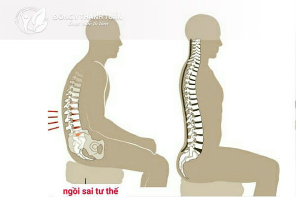 Ngồi sai tư thế là một trong những nguyên nhân gây đau lưng