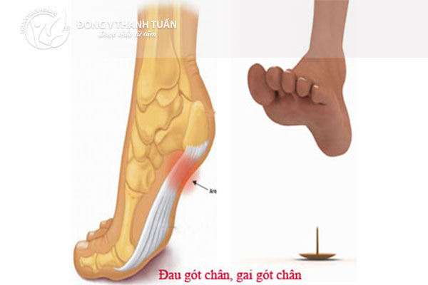 Bệnh gai gót chân gây đau thốn gót chân