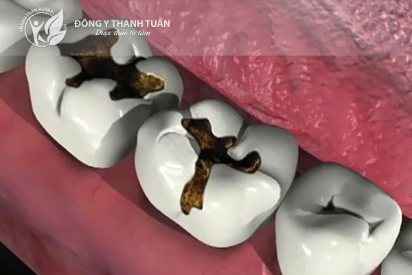 Răng sâu là nguyên nhân gây hôi miệng